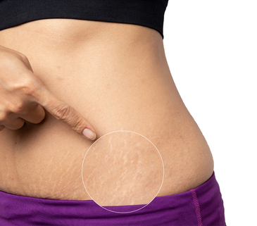 Fractional laser 