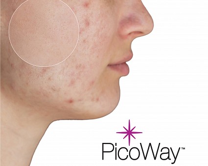 Picoway laser - Cosmetic laser surgery