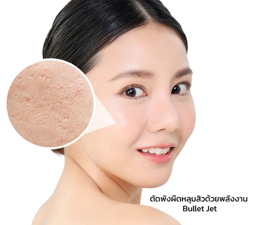 Enerjet จัดการทุกรอยหลุมสิว