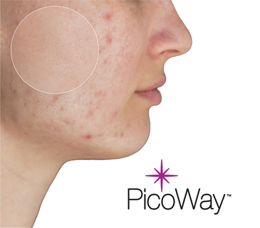Picoway resolve - Reduct lage pores