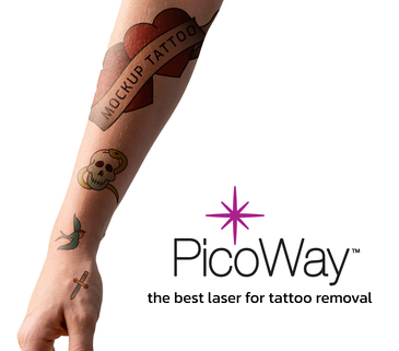 ลบรอยสัก ด้วย Picoway No1 laser